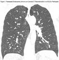 Visual Assessment of CT Findings in Smokers With Nonobstructed Spirometric Abnormalities in the COPDGene® Study