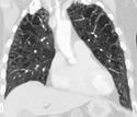 Images in COPD: Combined Pulmonary Fibrosis and Emphysema