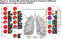 The Human Microbiome in the Lung: Are Infections Contributing to Lung Health and Disease?