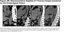 Hiatal Hernia on Chest High-Resolution Computed Tomography and Exacerbation Rates in COPD Individuals