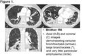 Images in COPD: Alpha-1 Antitrypsin Deficiency and Bronchiectasis