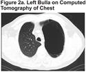 Images in COPD: Giant Bullous Emphysema