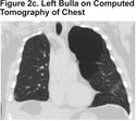 Images in COPD: Giant Bullous Emphysema