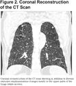 Images in COPD: Combined Pulmonary Emphysema and Fibrosis with Pulmonary Hypertension