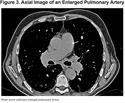 Images in COPD: Combined Pulmonary Emphysema and Fibrosis with Pulmonary Hypertension