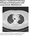 Combined Pulmonary Fibrosis and Emphysema