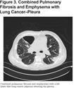 Combined Pulmonary Fibrosis and Emphysema