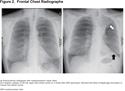 Bronchoscopic Lung Volume Reduction Using Endobronchial Valves: Imaging Appearance