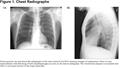 Images in COPD: Idiopathic Emphysema in a Never Smoker