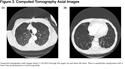 Images in COPD: Idiopathic Emphysema in a Never Smoker