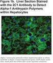 The Alpha-1 Antitrypsin Polymer Load Correlates With Hepatocyte Senescence, Fibrosis Stage and Liver-Related Mortality