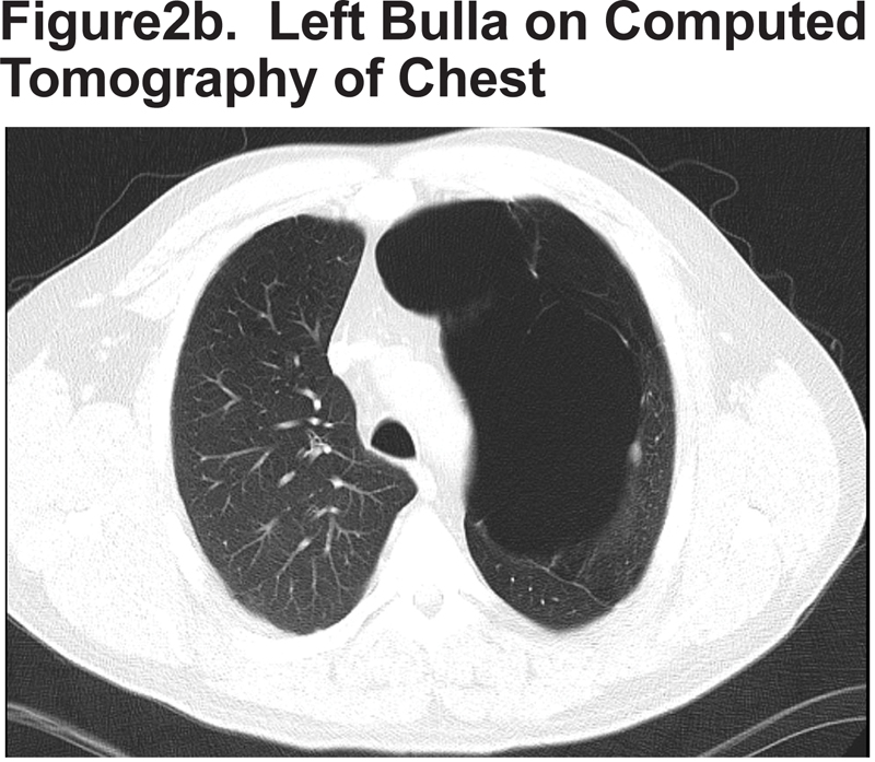 Images in COPD: Giant Bullous Emphysema  Journal of COPD 